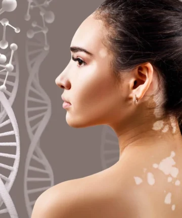 Vitiligo